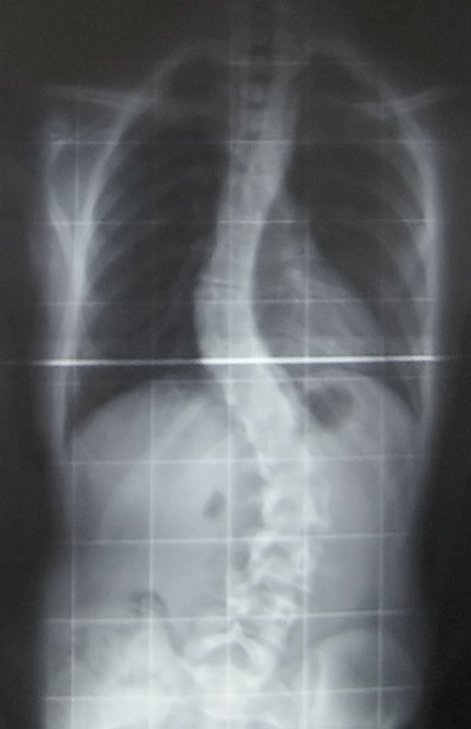 radiographie d'une scoliose
